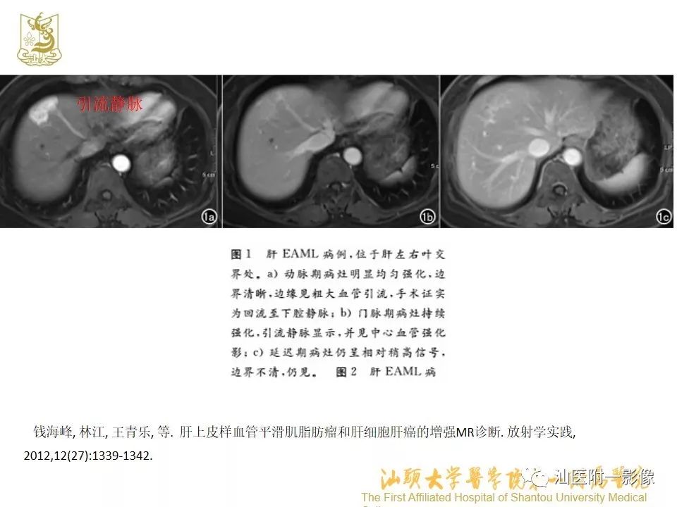 影像PPT - 【PPT】肝脏“快进快出强化” 肿瘤简析-12