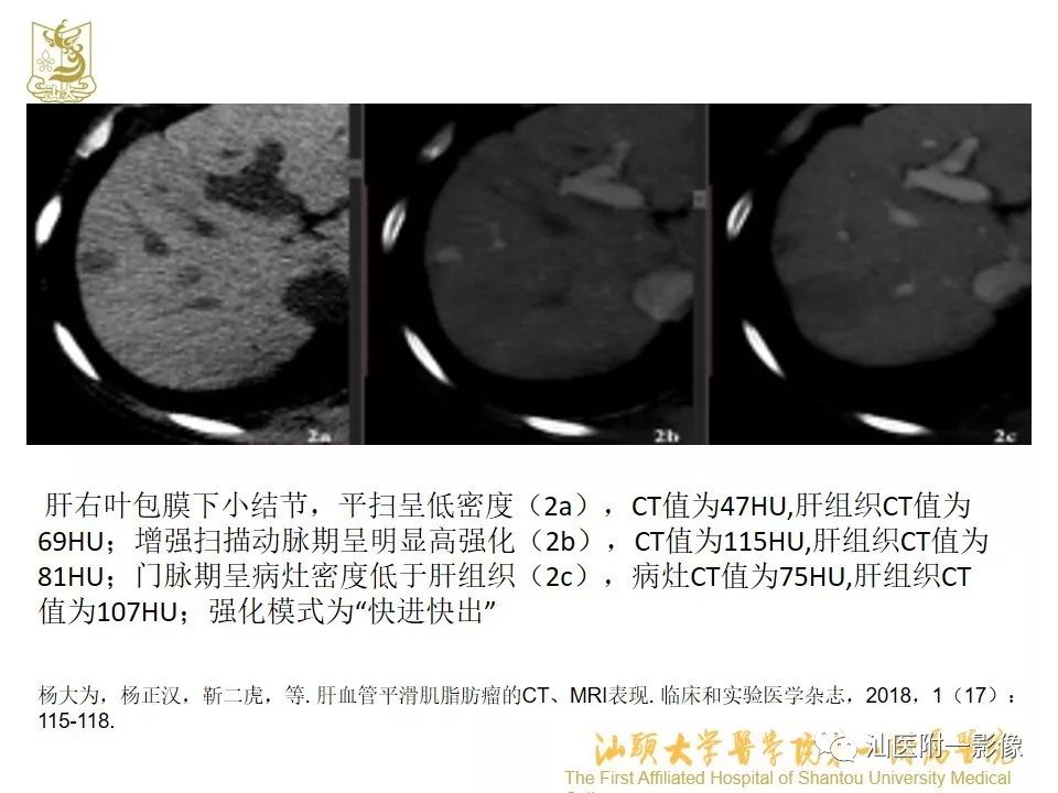影像PPT - 【PPT】肝脏“快进快出强化” 肿瘤简析-13