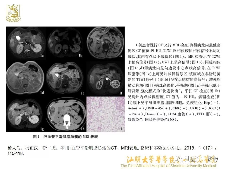 影像PPT - 【PPT】肝脏“快进快出强化” 肿瘤简析-14