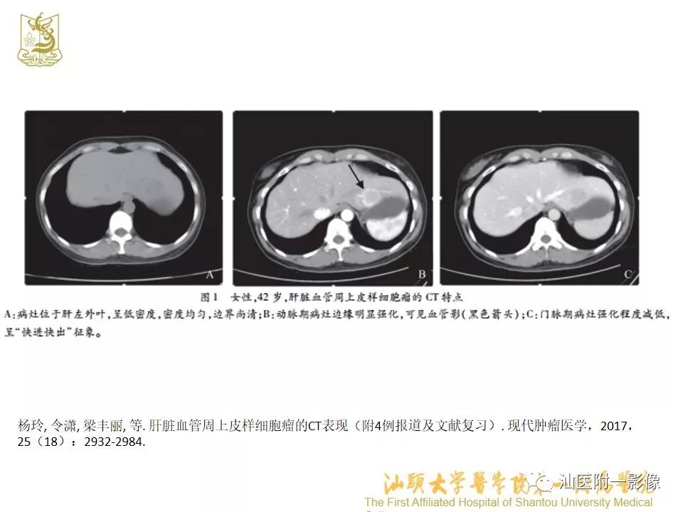 影像PPT - 【PPT】肝脏“快进快出强化” 肿瘤简析-15
