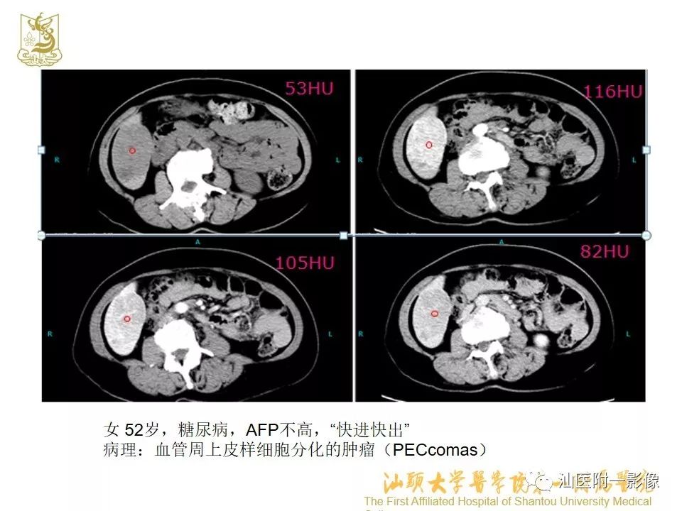 影像PPT - 【PPT】肝脏“快进快出强化” 肿瘤简析-16