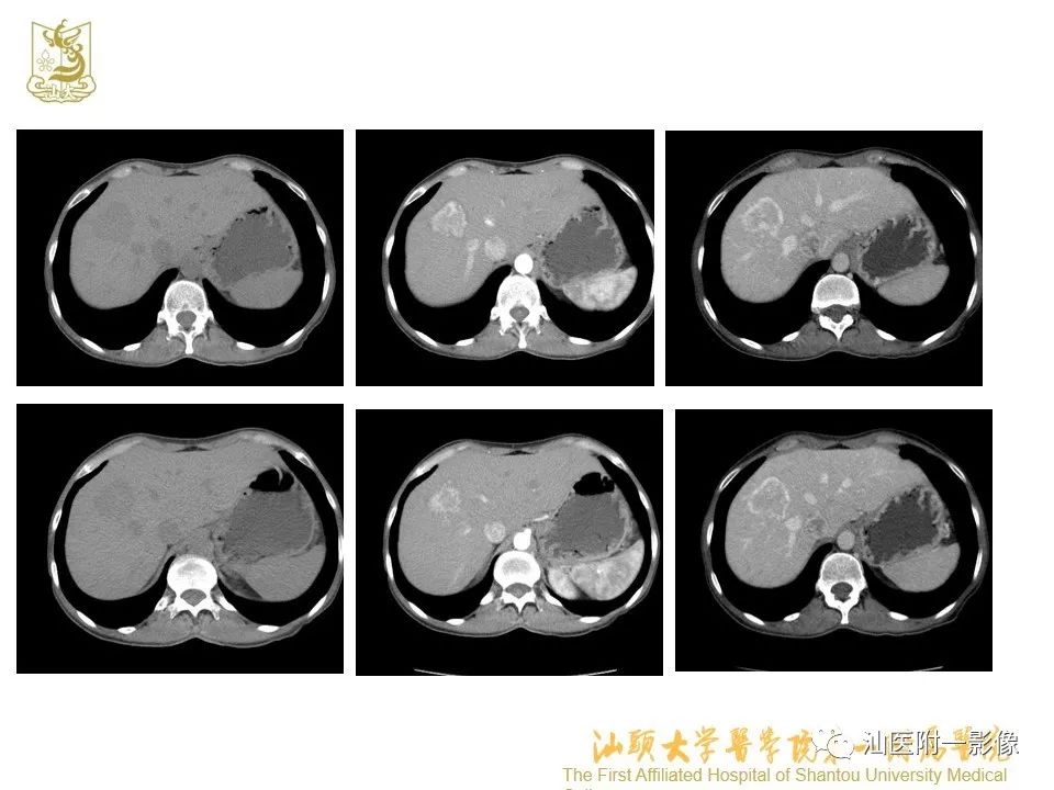 影像PPT - 【PPT】肝脏“快进快出强化” 肿瘤简析-19