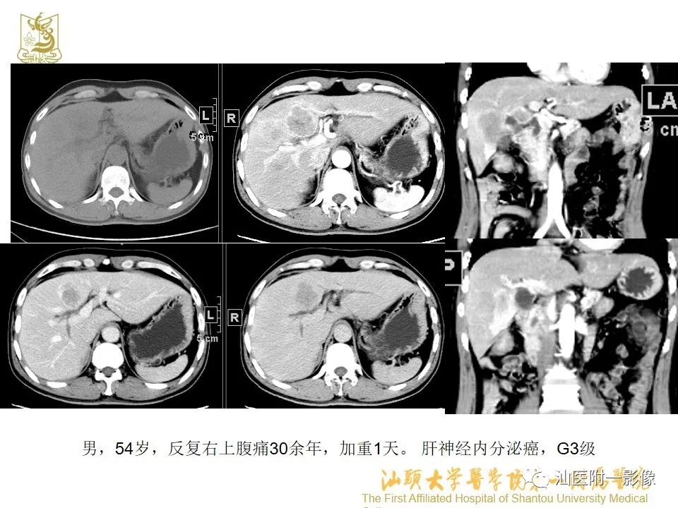 影像PPT - 【PPT】肝脏“快进快出强化” 肿瘤简析-21