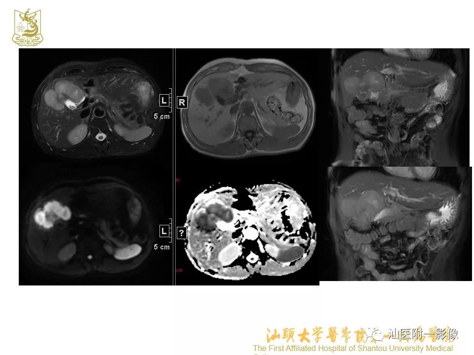 影像PPT - 【PPT】肝脏“快进快出强化” 肿瘤简析-22