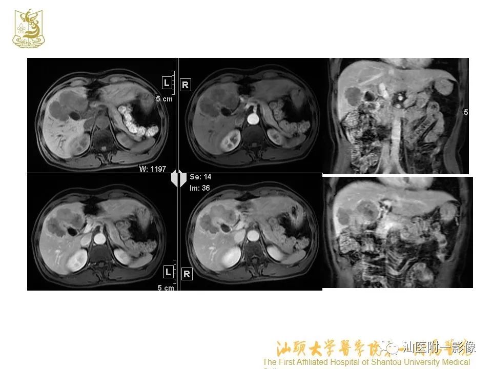 影像PPT - 【PPT】肝脏“快进快出强化” 肿瘤简析-23