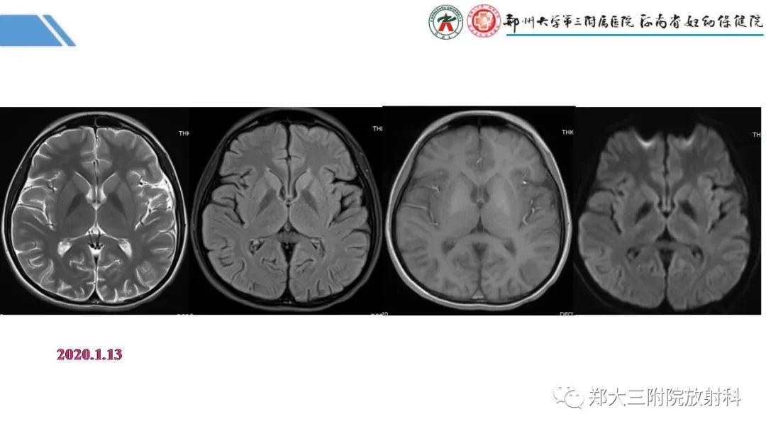 影像PPT - 【PPT】Melas综合征的影像诊断-3