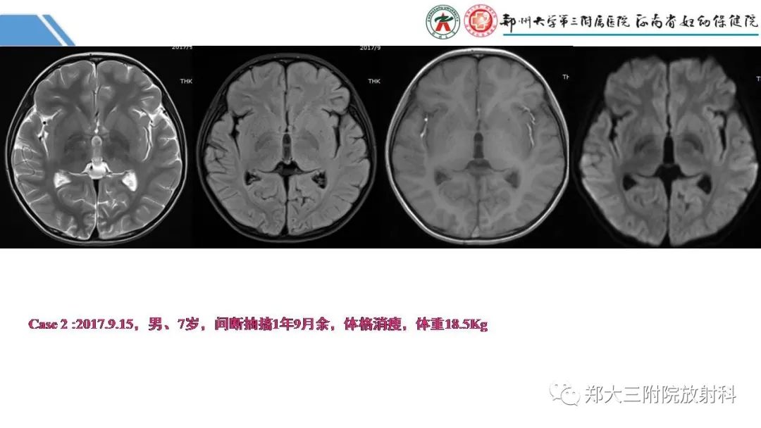 影像PPT - 【PPT】Melas综合征的影像诊断-7