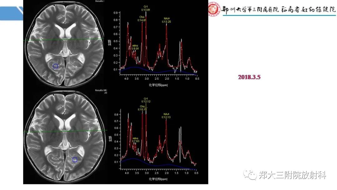 影像PPT - 【PPT】Melas综合征的影像诊断-9