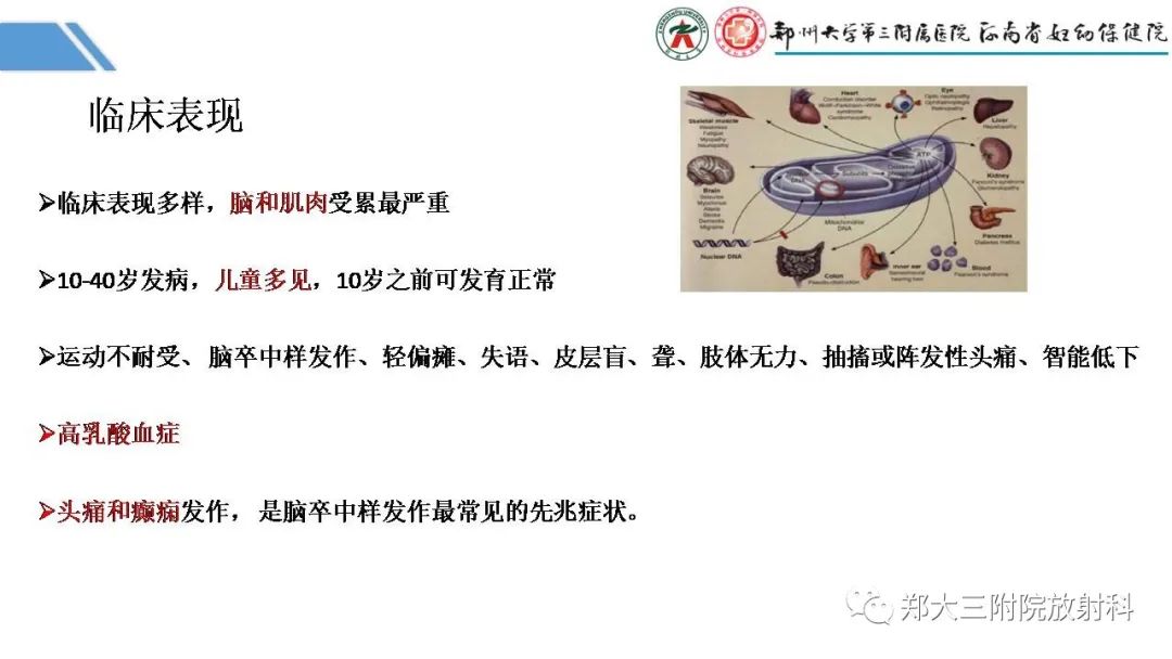 影像PPT - 【PPT】Melas综合征的影像诊断-16