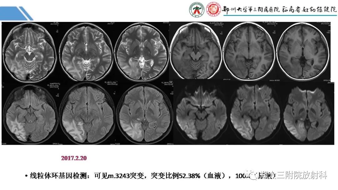 影像PPT - 【PPT】Melas综合征的影像诊断-22