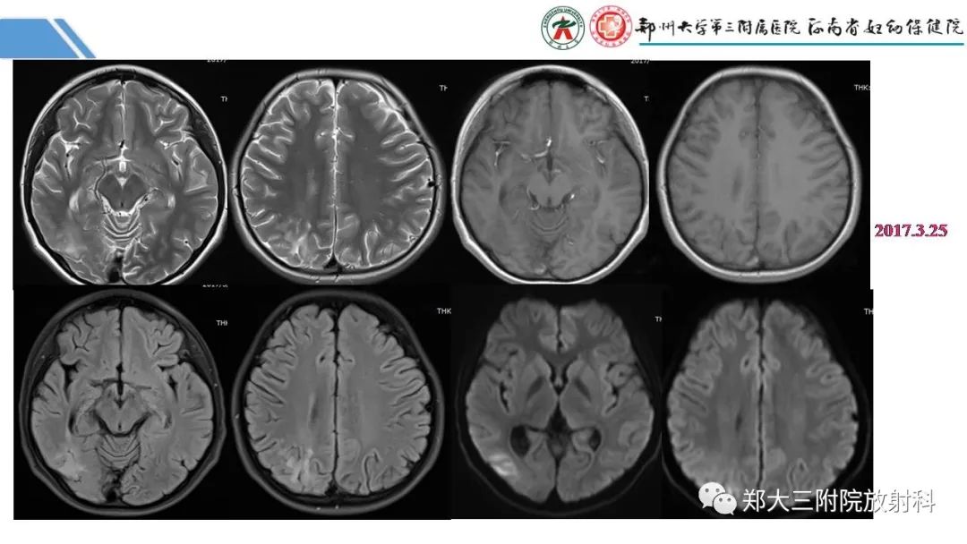 影像PPT - 【PPT】Melas综合征的影像诊断-23