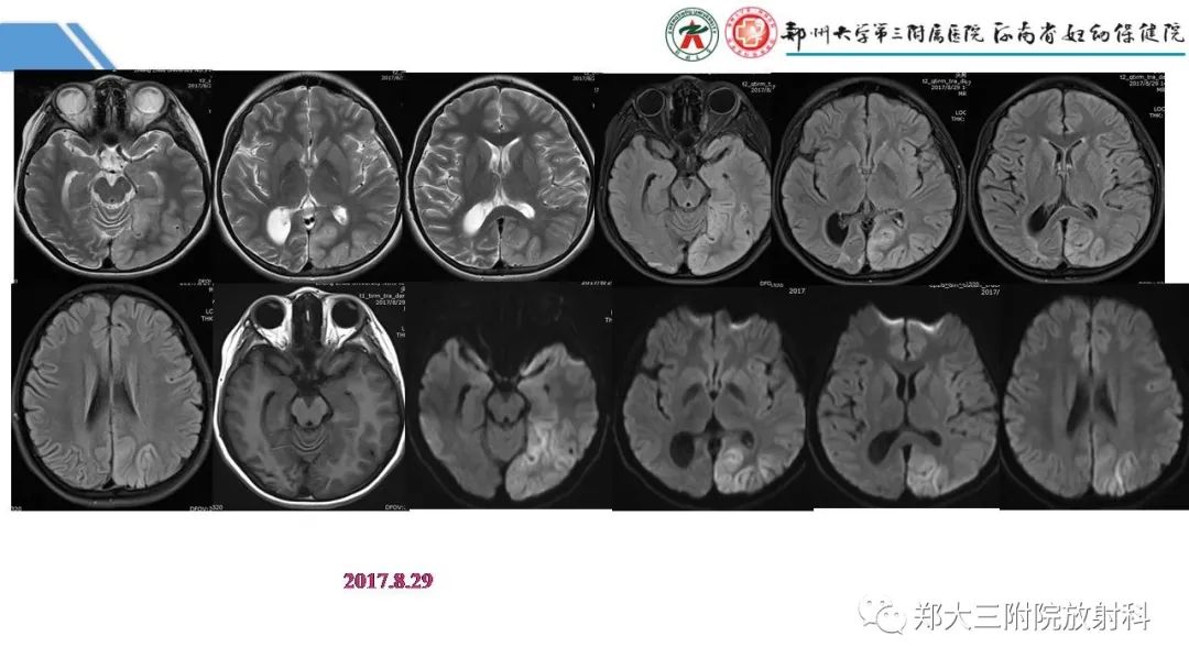 影像PPT - 【PPT】Melas综合征的影像诊断-25