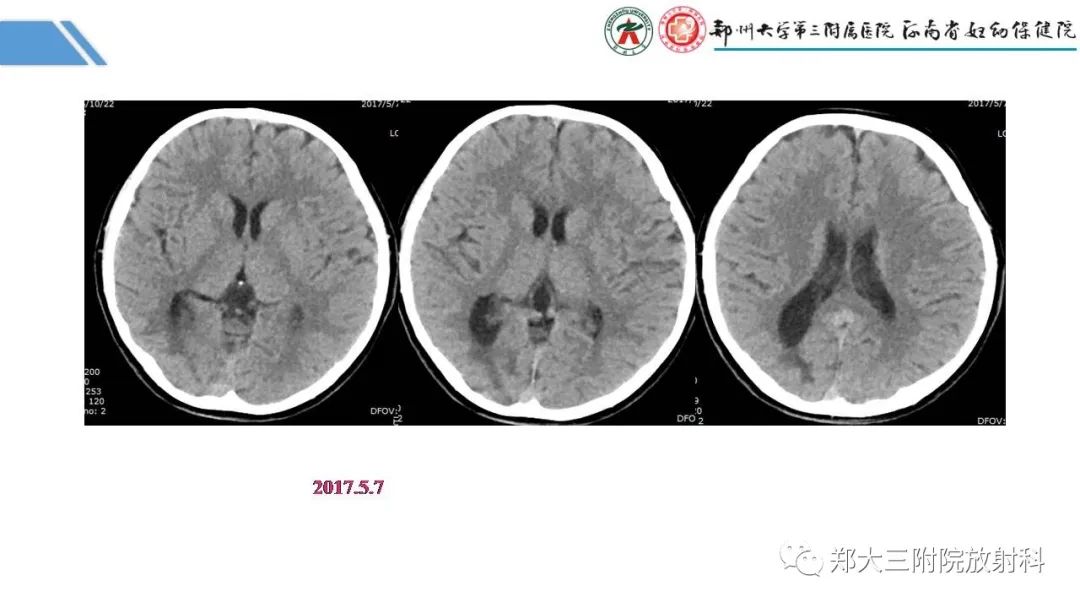 影像PPT - 【PPT】Melas综合征的影像诊断-24