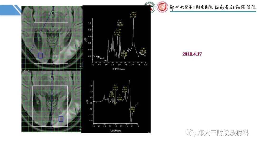 影像PPT - 【PPT】Melas综合征的影像诊断-26