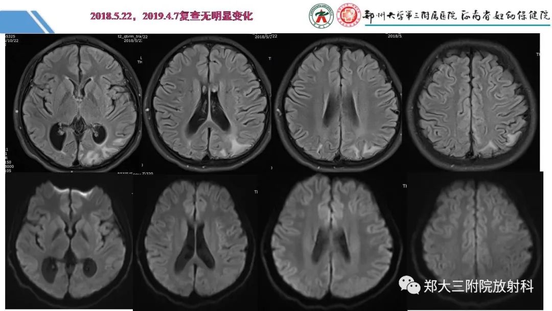 影像PPT - 【PPT】Melas综合征的影像诊断-27