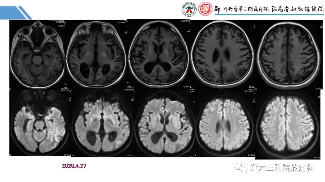 影像PPT - 【PPT】Melas综合征的影像诊断-29