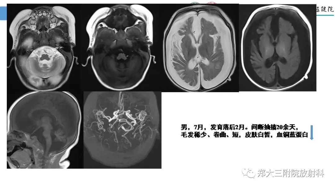 影像PPT - 【PPT】Melas综合征的影像诊断-35
