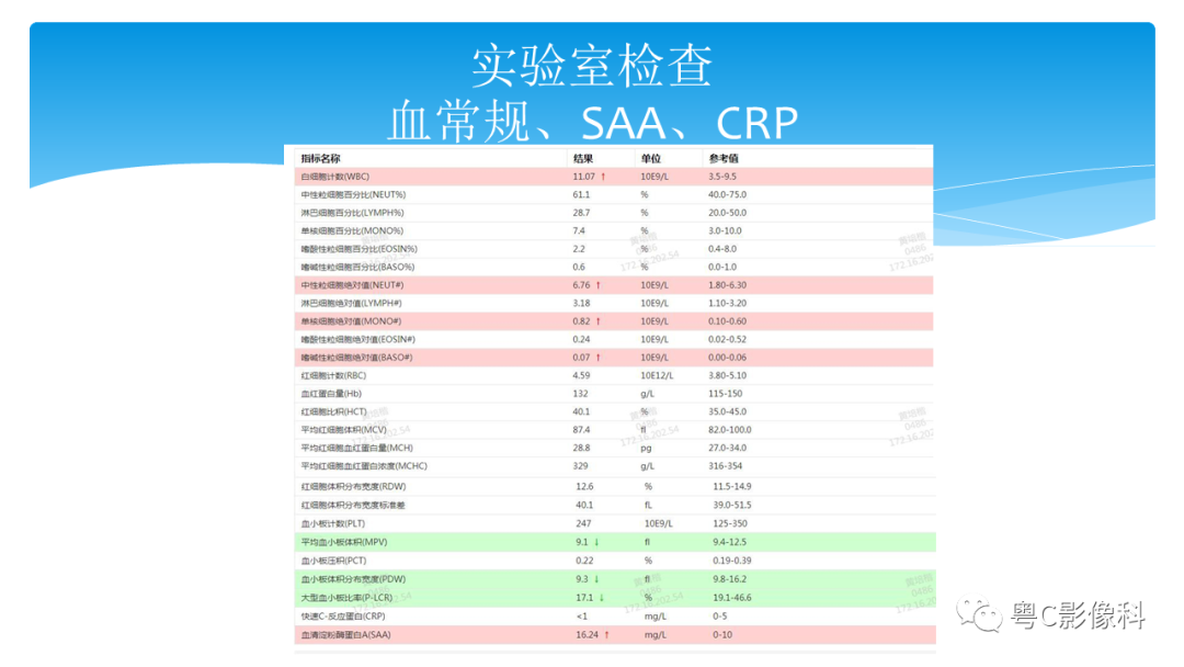 影像PPT - 【PPT】亨特综合征-4 影像PPT - 【PPT】亨特综合征-4