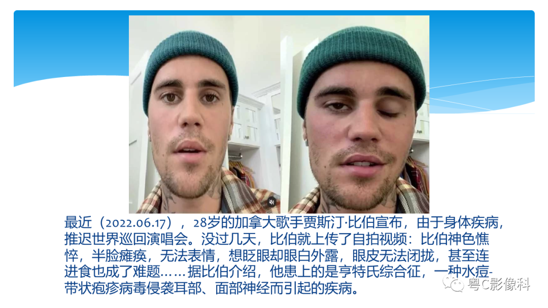 影像PPT - 【PPT】亨特综合征-21 影像PPT - 【PPT】亨特综合征-21