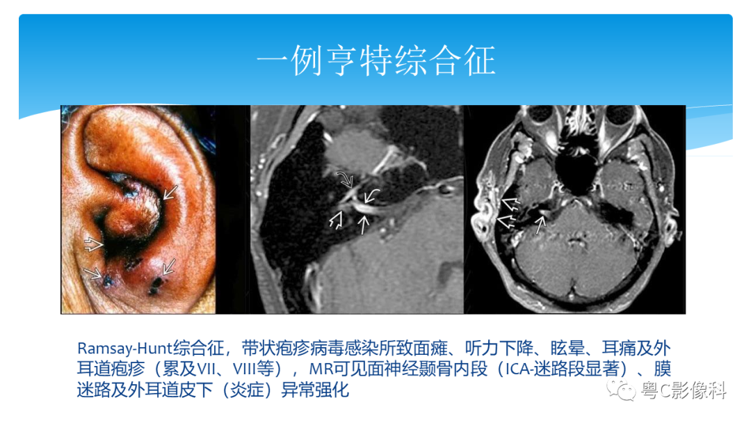 影像PPT - 【PPT】亨特综合征-25 影像PPT - 【PPT】亨特综合征-25