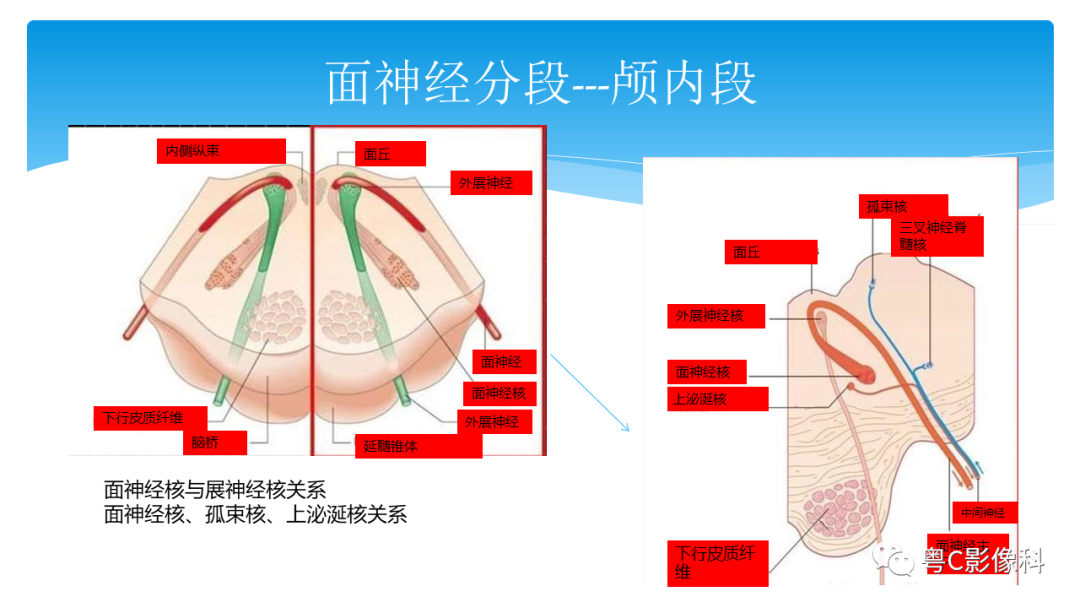影像PPT - 【PPT】亨特综合征-30 影像PPT - 【PPT】亨特综合征-30