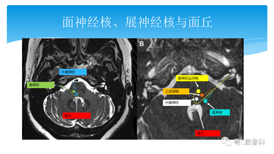 影像PPT - 【PPT】亨特综合征-31 影像PPT - 【PPT】亨特综合征-31