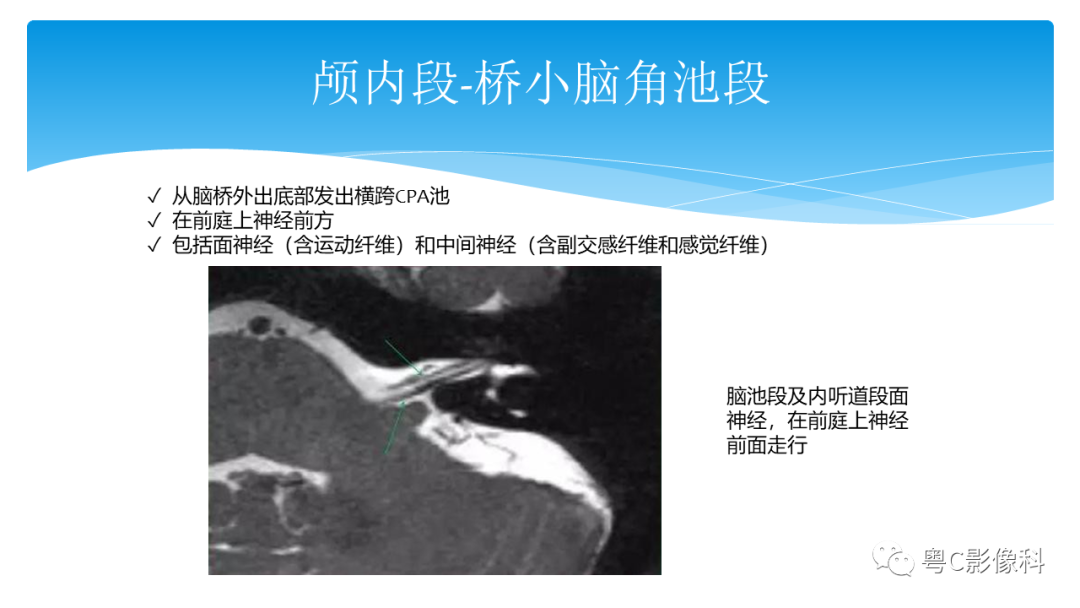 影像PPT - 【PPT】亨特综合征-32 影像PPT - 【PPT】亨特综合征-32