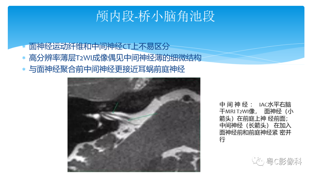 影像PPT - 【PPT】亨特综合征-33 影像PPT - 【PPT】亨特综合征-33