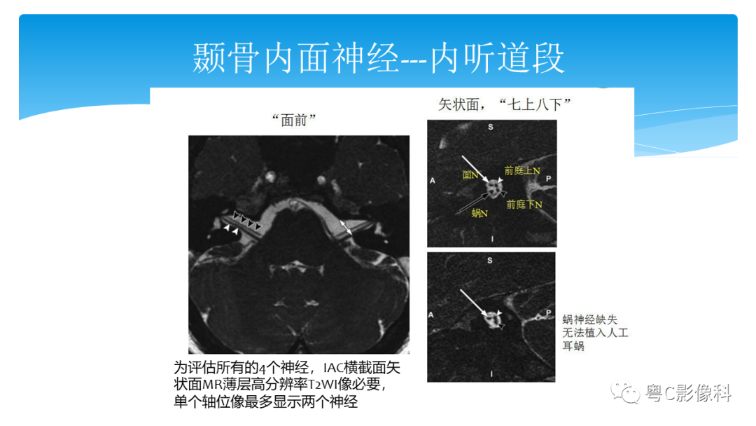 影像PPT - 【PPT】亨特综合征-37 影像PPT - 【PPT】亨特综合征-37