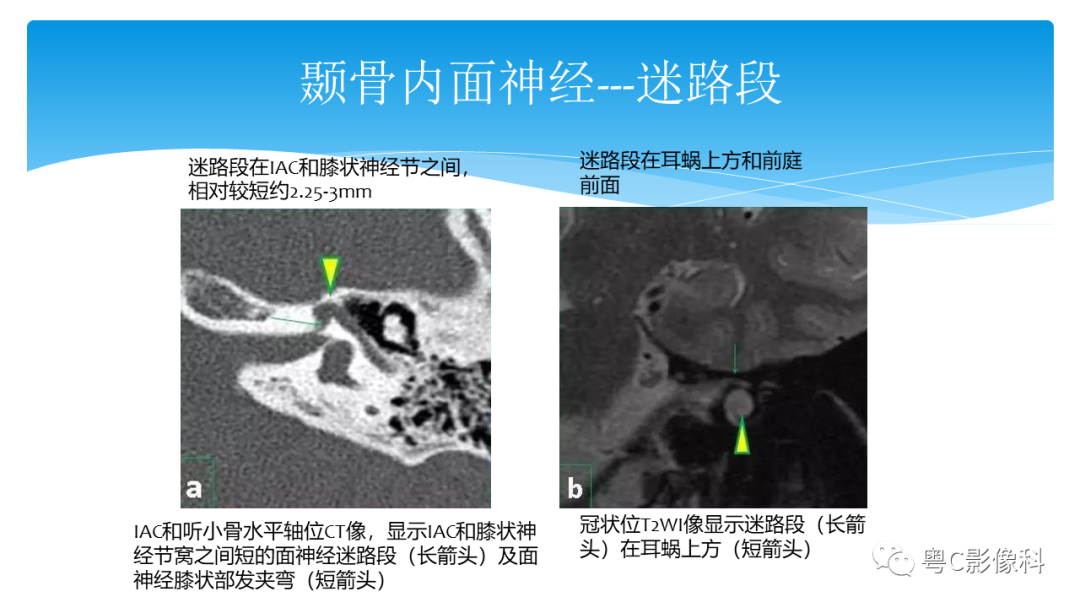 影像PPT - 【PPT】亨特综合征-40 影像PPT - 【PPT】亨特综合征-40