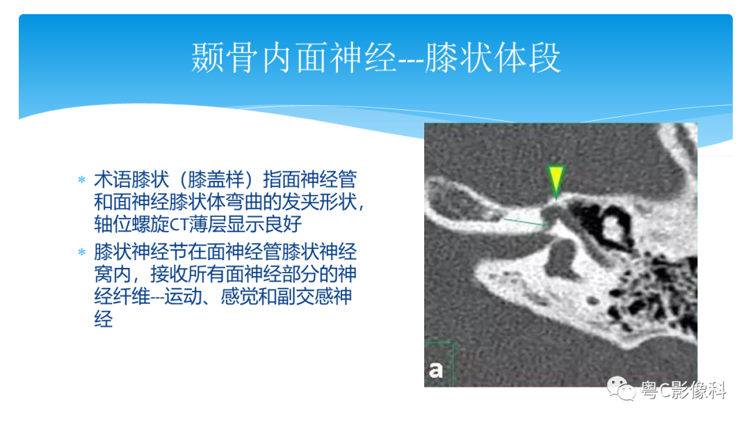 影像PPT - 【PPT】亨特综合征-41 影像PPT - 【PPT】亨特综合征-41