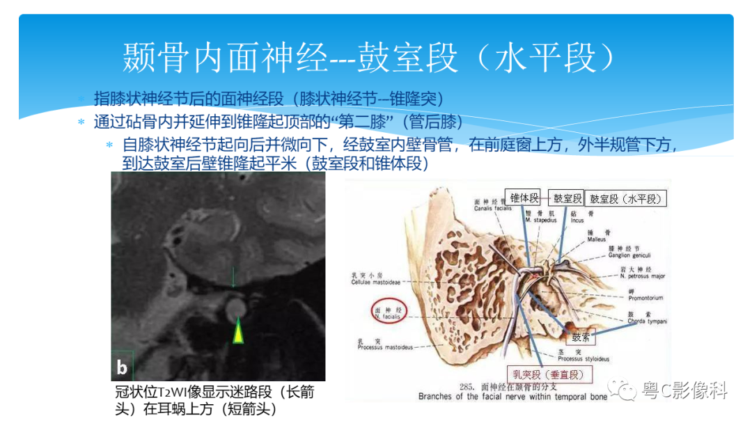 影像PPT - 【PPT】亨特综合征-43 影像PPT - 【PPT】亨特综合征-43