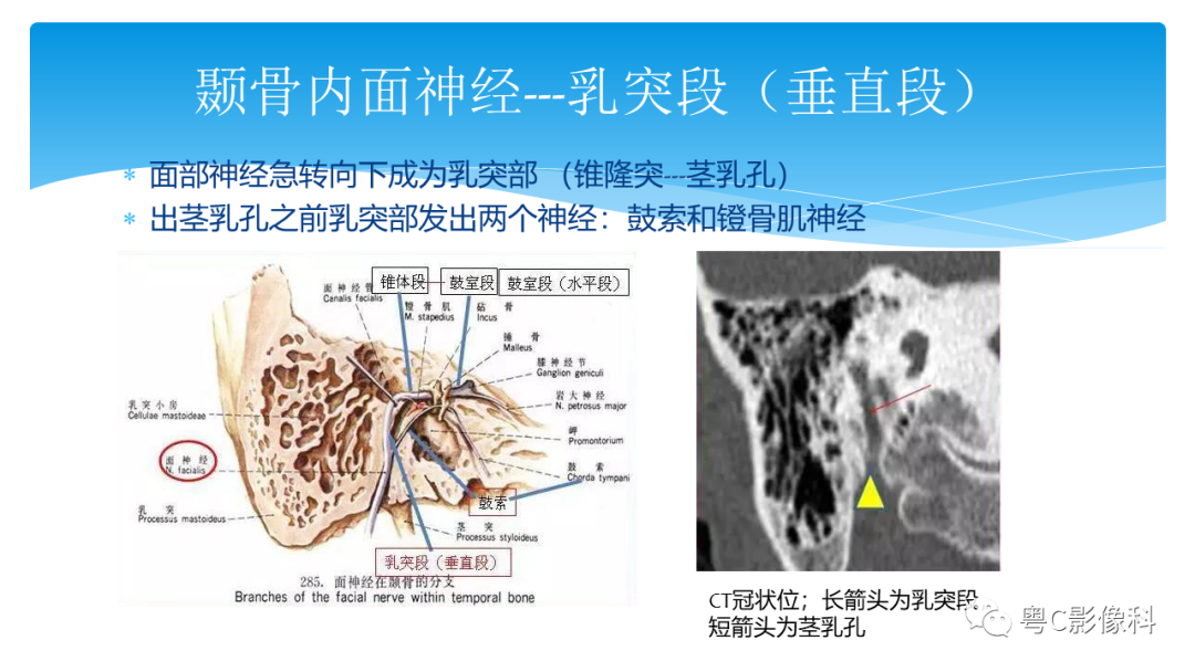 影像PPT - 【PPT】亨特综合征-44 影像PPT - 【PPT】亨特综合征-44