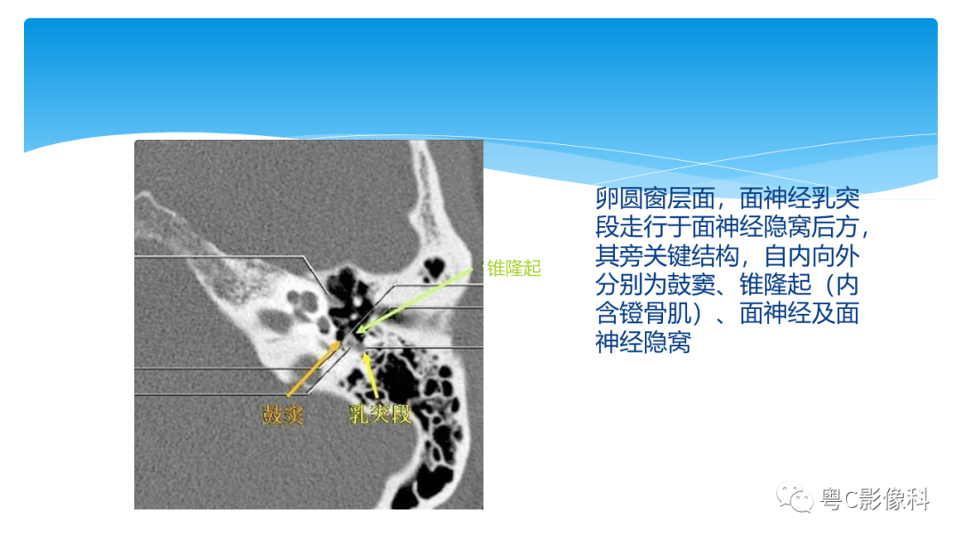 影像PPT - 【PPT】亨特综合征-47 影像PPT - 【PPT】亨特综合征-47