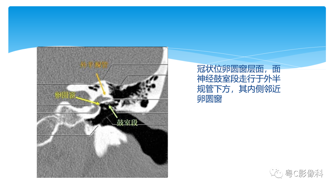 影像PPT - 【PPT】亨特综合征-48 影像PPT - 【PPT】亨特综合征-48