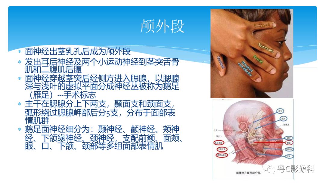 影像PPT - 【PPT】亨特综合征-54 影像PPT - 【PPT】亨特综合征-54