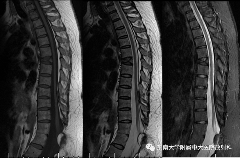 影像PPT - 【PPT】脊髓栓系综合征-3 影像PPT - 【PPT】脊髓栓系综合征-3
