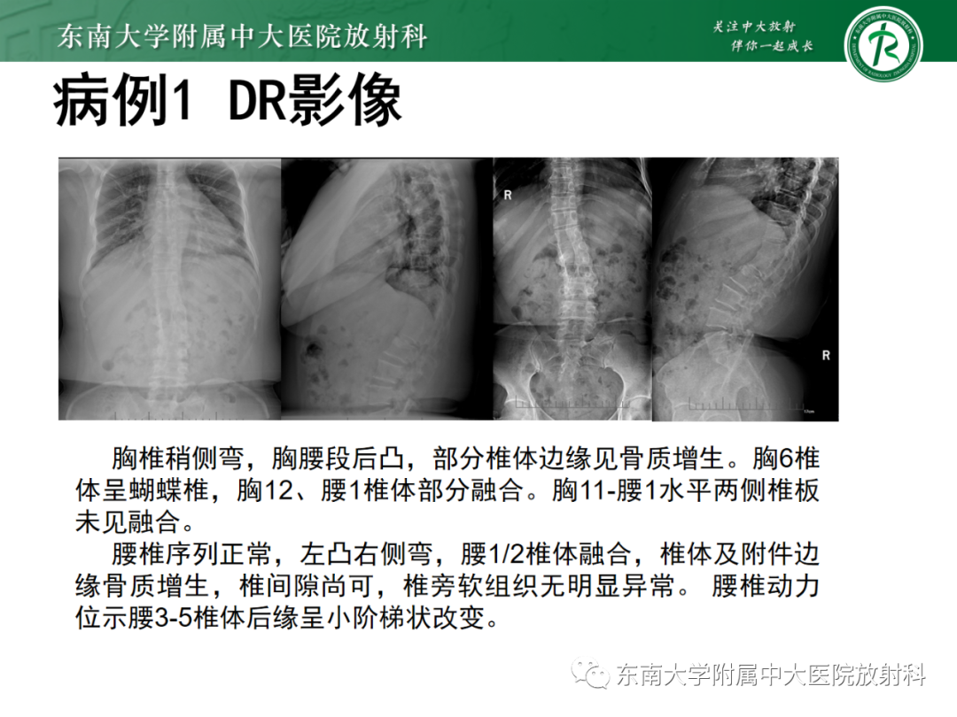 影像PPT - 【PPT】脊髓栓系综合征-4 影像PPT - 【PPT】脊髓栓系综合征-4