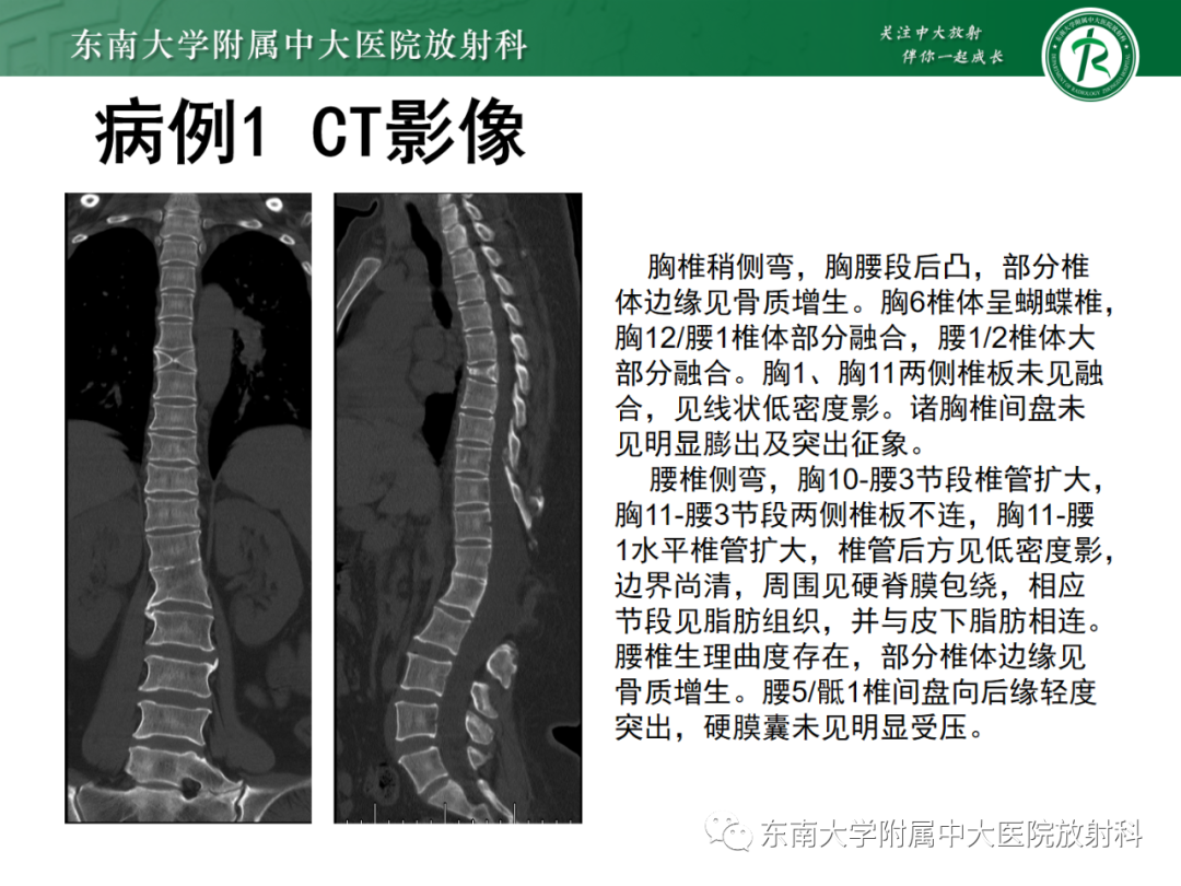 影像PPT - 【PPT】脊髓栓系综合征-5 影像PPT - 【PPT】脊髓栓系综合征-5