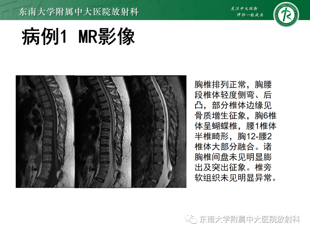 影像PPT - 【PPT】脊髓栓系综合征-6 影像PPT - 【PPT】脊髓栓系综合征-6