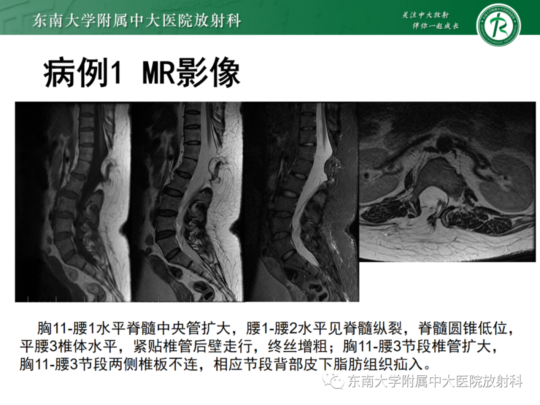 影像PPT - 【PPT】脊髓栓系综合征-7 影像PPT - 【PPT】脊髓栓系综合征-7