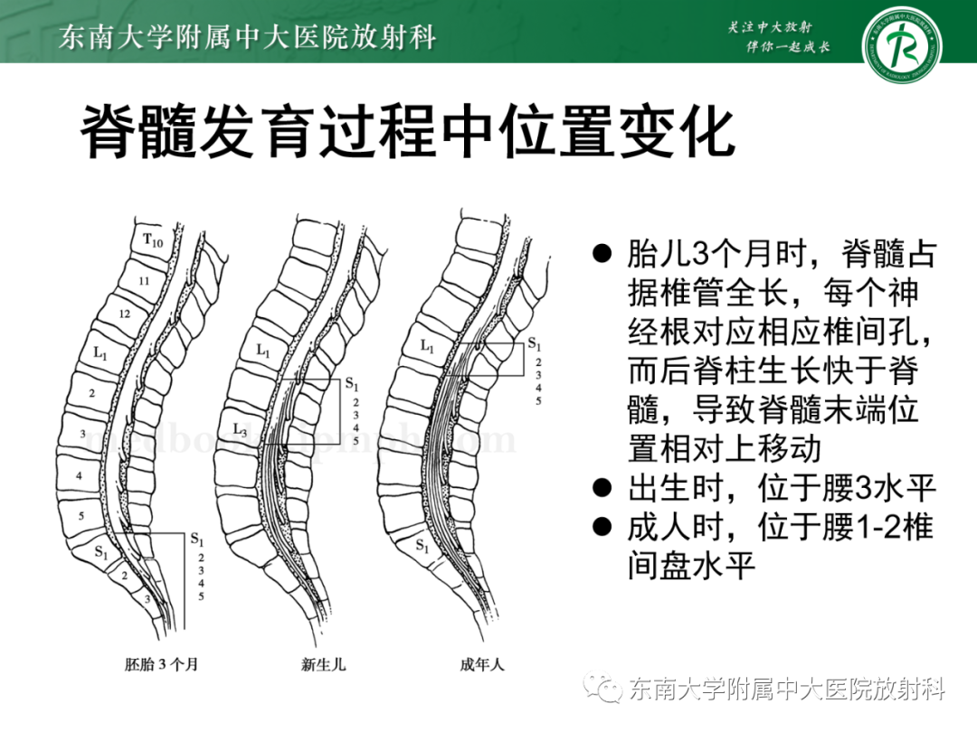 影像PPT - 【PPT】脊髓栓系综合征-11 影像PPT - 【PPT】脊髓栓系综合征-11