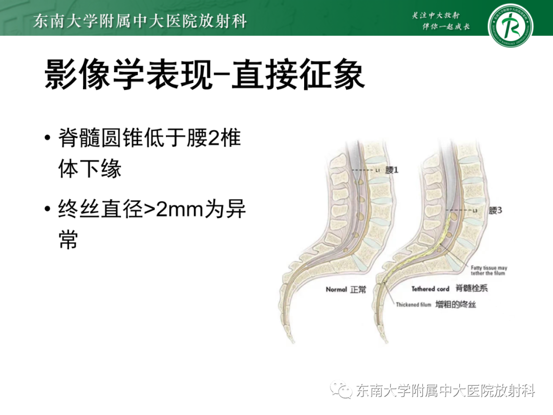 影像PPT - 【PPT】脊髓栓系综合征-21 影像PPT - 【PPT】脊髓栓系综合征-21