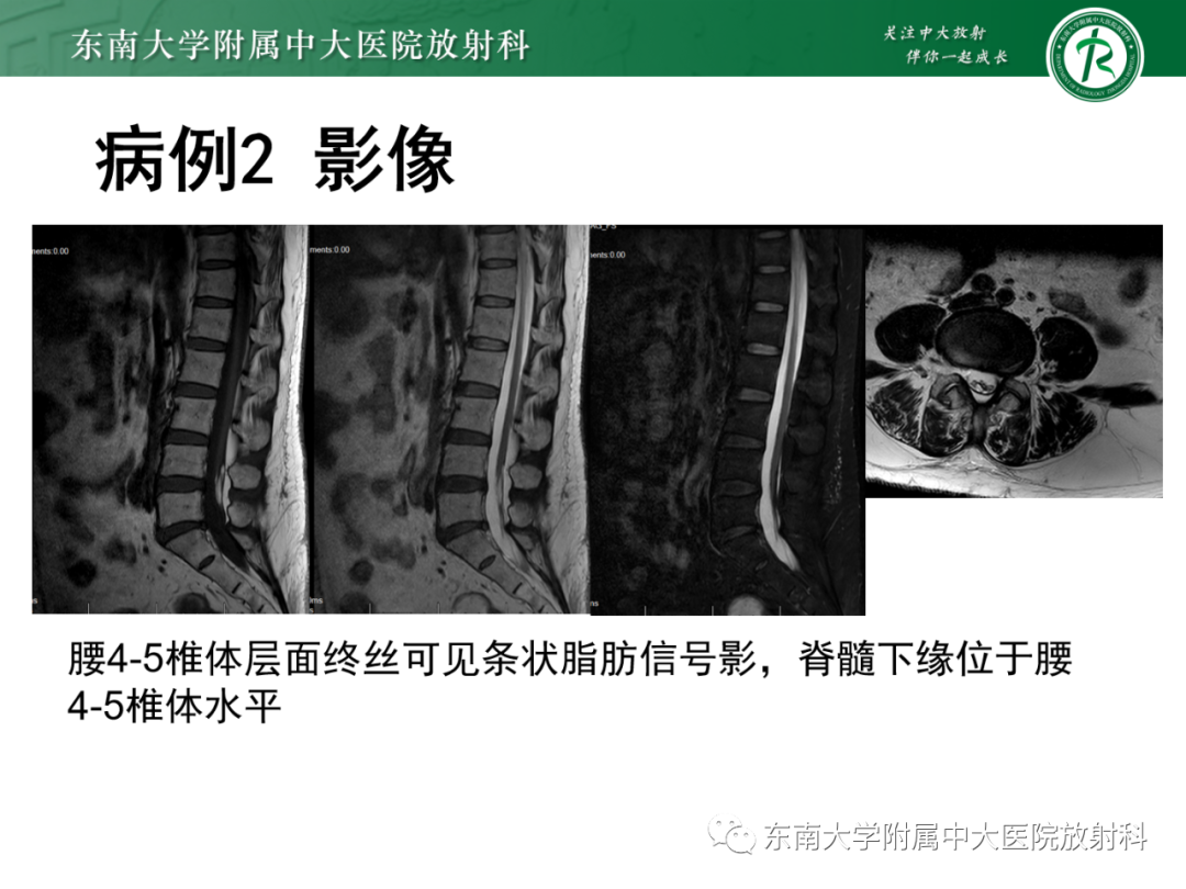 影像PPT - 【PPT】脊髓栓系综合征-23 影像PPT - 【PPT】脊髓栓系综合征-23