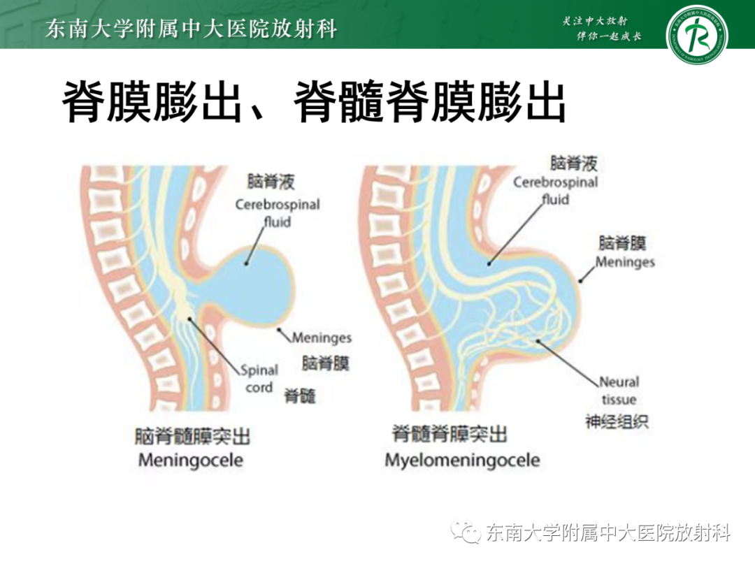 影像PPT - 【PPT】脊髓栓系综合征-25 影像PPT - 【PPT】脊髓栓系综合征-25