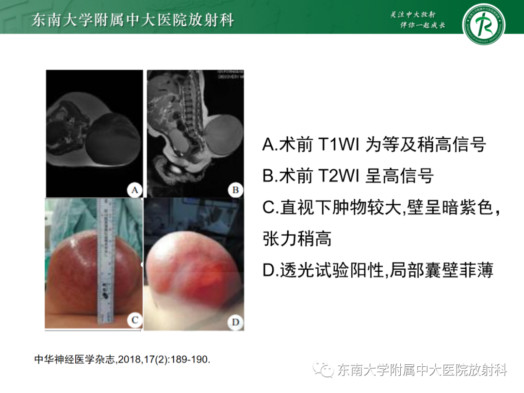 影像PPT - 【PPT】脊髓栓系综合征-26 影像PPT - 【PPT】脊髓栓系综合征-26