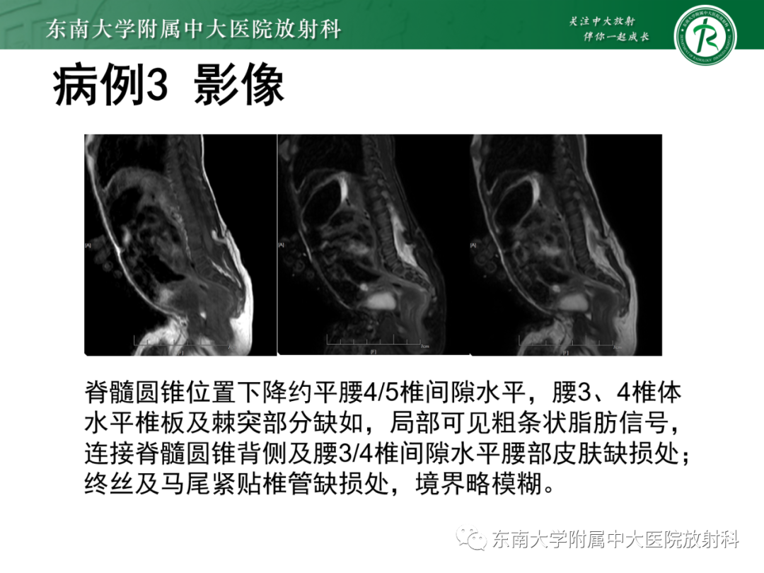 影像PPT - 【PPT】脊髓栓系综合征-28 影像PPT - 【PPT】脊髓栓系综合征-28