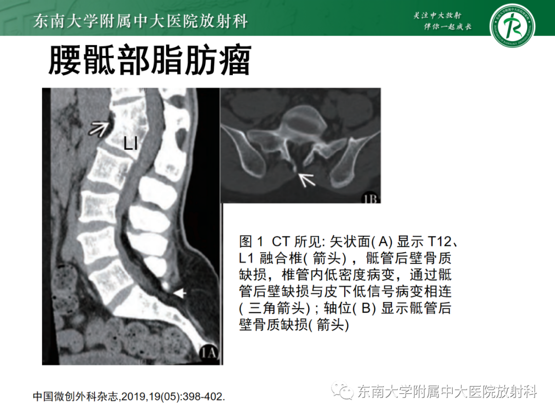 影像PPT - 【PPT】脊髓栓系综合征-29 影像PPT - 【PPT】脊髓栓系综合征-29
