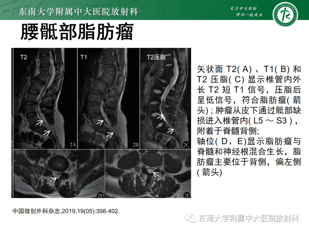 影像PPT - 【PPT】脊髓栓系综合征-30 影像PPT - 【PPT】脊髓栓系综合征-30
