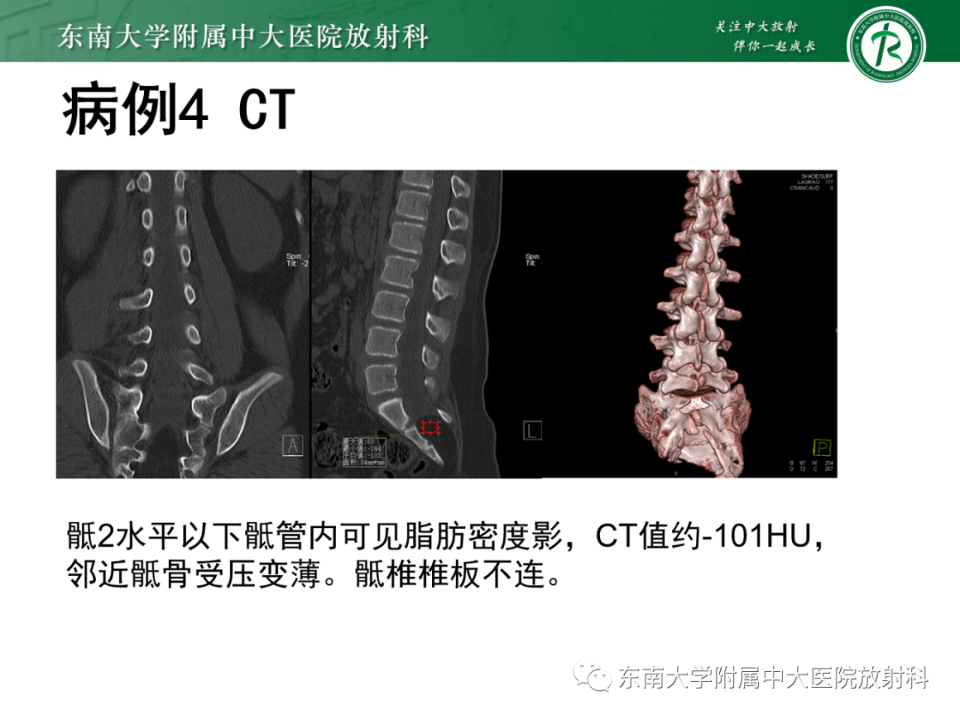 影像PPT - 【PPT】脊髓栓系综合征-32 影像PPT - 【PPT】脊髓栓系综合征-32